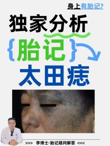 臉上有胎記好嗎？體相中面部胎記詳細分析