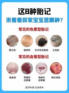 胎記的形狀與命運 不同的胎記寓意如何