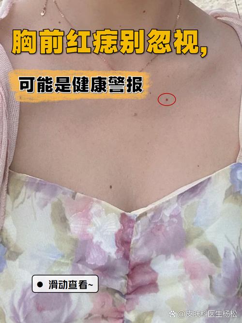 女人胸前有紅痣代表什么