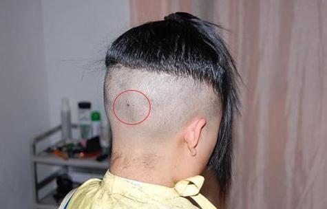 后腦勺下有痣藏頭發里