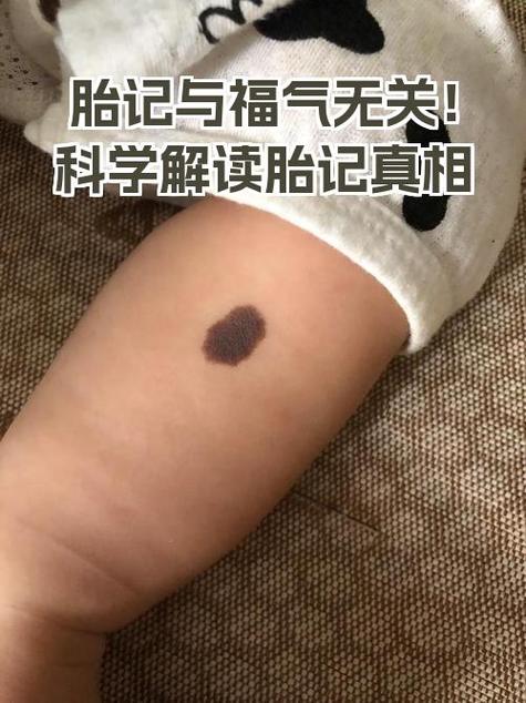 腿上胎記預示著什么