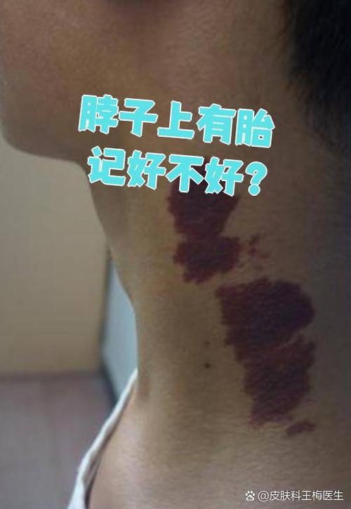 脖子有胎記會怎樣，脖子胎記好不好