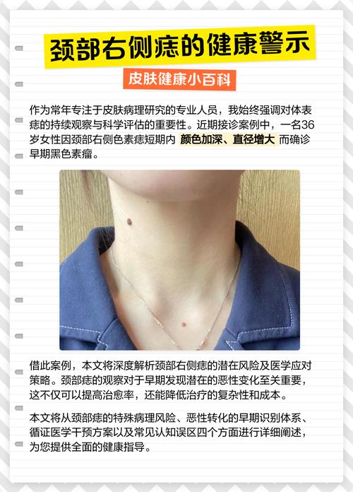 脖子上有痣的男人代表什么 脖頸上右側有長痣代表什么